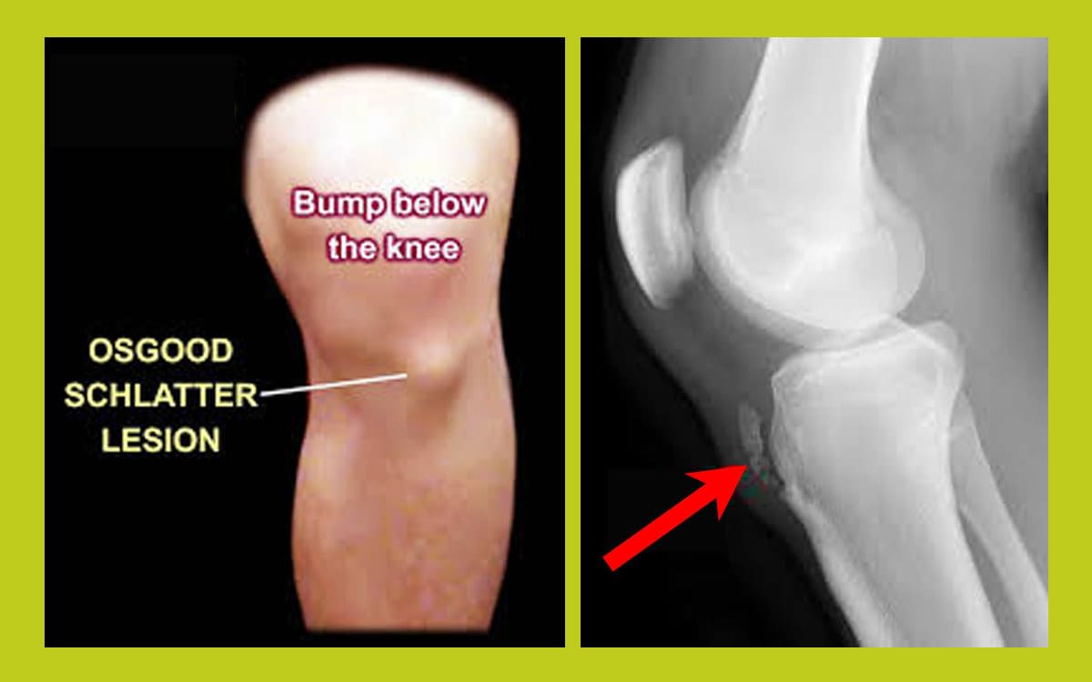 heck is that bump below my knee 