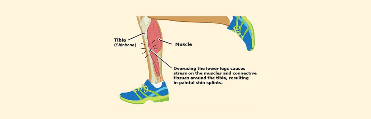 Shin Splints; a Runner's most Feared Injury! | Easthill Physiotherapy